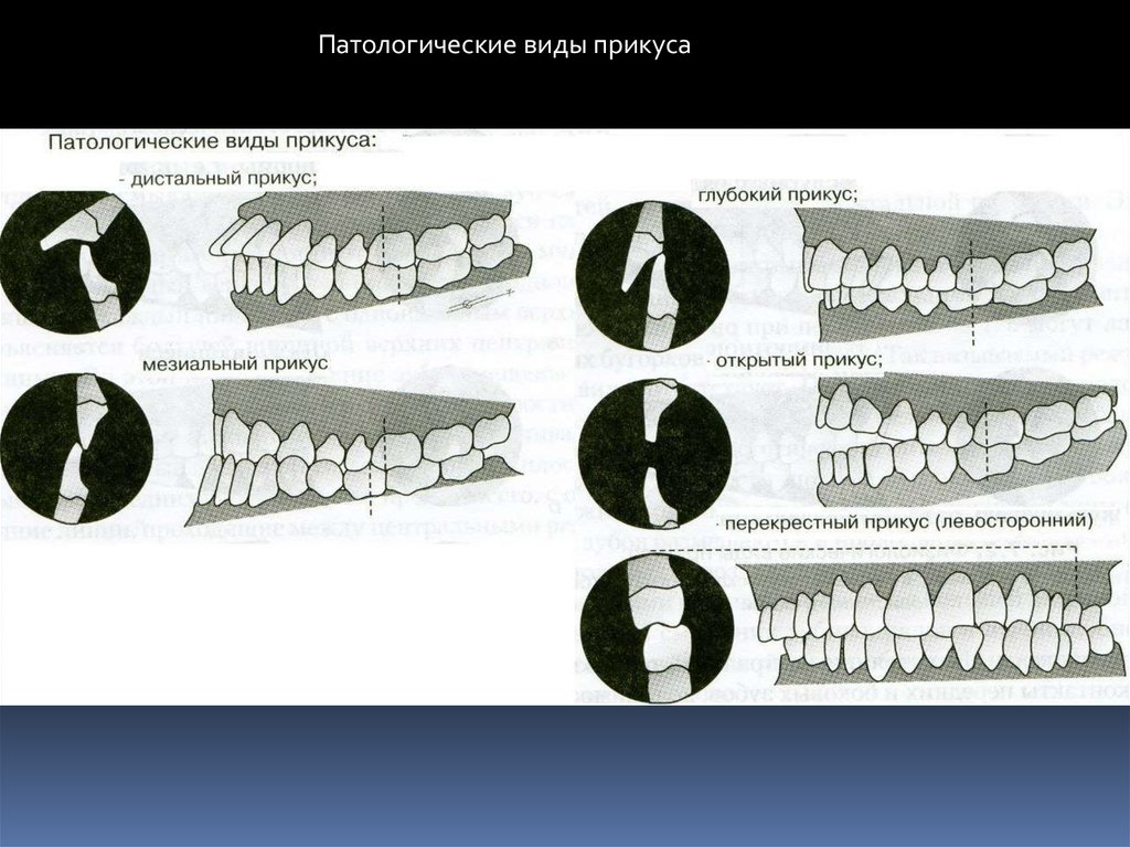 Виды прикусов презентация