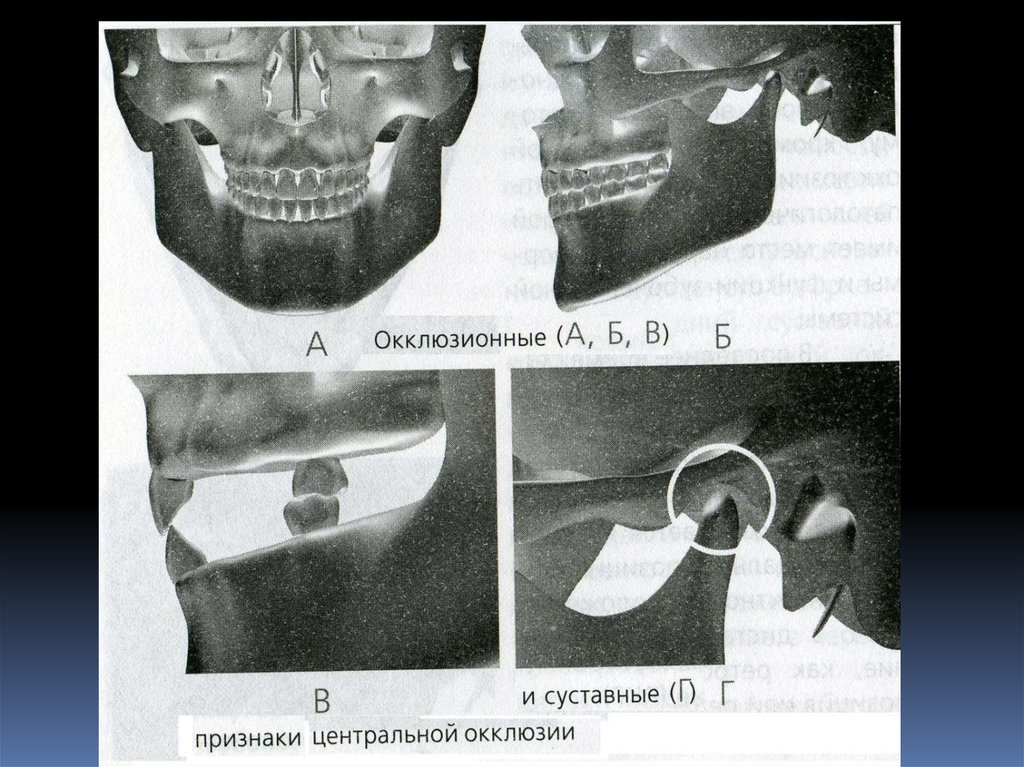 Положение центральной окклюзии. Суставной признак центральной окклюзии. Суставной признак центральной окклюзии суставная. Сумтавной признак централтной пкклюдии. Признаки центральной окклюзии.