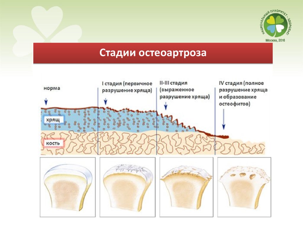 Остеоартроз 1 степени. Стадии развития остеоартроза. Степени развития остеоартроза.