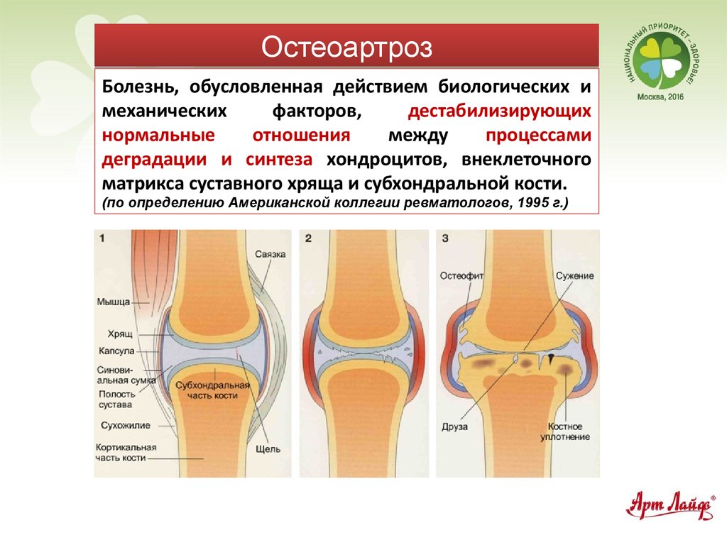 Остеоартроз что это такое как лечить. Деформирующий остеоартроз синовиальная жидкость. Деформирующий остеоартроз поражение суставов. Поражение суставов при остеоартрите.