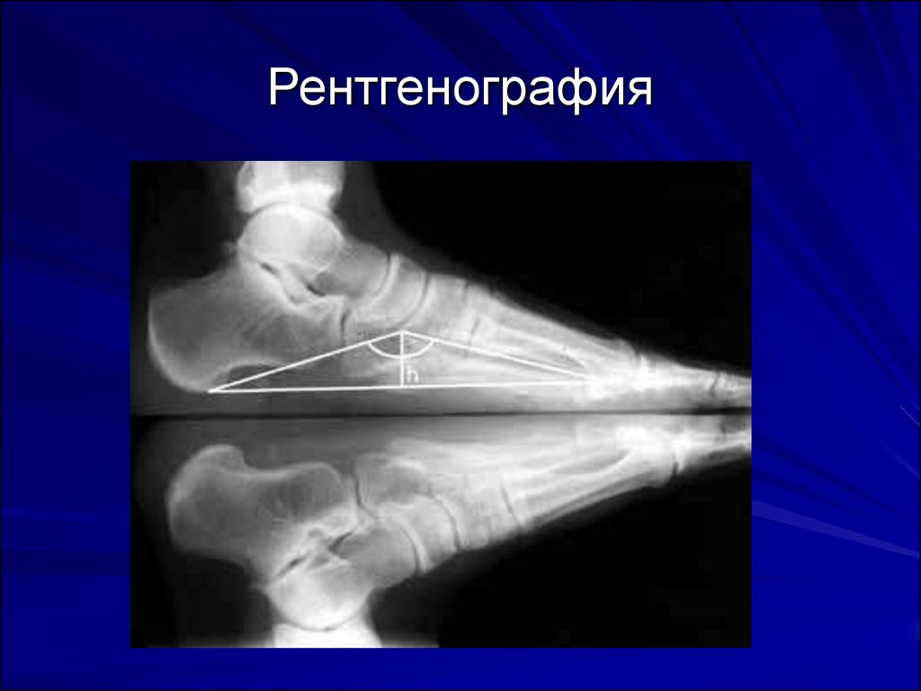 Рентген стоп. Рентген стоп на продольное плоскостопие. Продольное плоскостопие рентген степени. Угол продольного свода стопы. Продольное плоскостопие углы рентген.