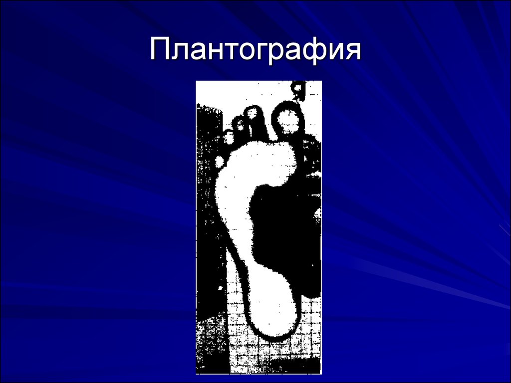 Плантография. Проведение плантографии. Плантография метод. Плантограмма, плантография это.