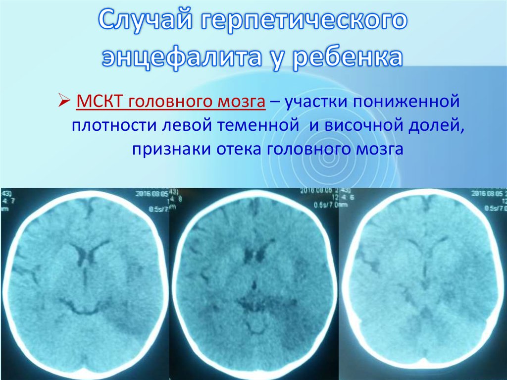 Воспаление мозга лечение