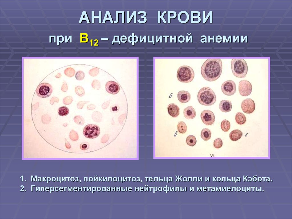 В12 при железодефицитной анемии. Анализ крови при анемии в12 дефицитной анемии. Б12 дефицитная анемия картина крови. Гиперсегментированные нейтрофилы. Кровь при б12 дефицитной анемии.
