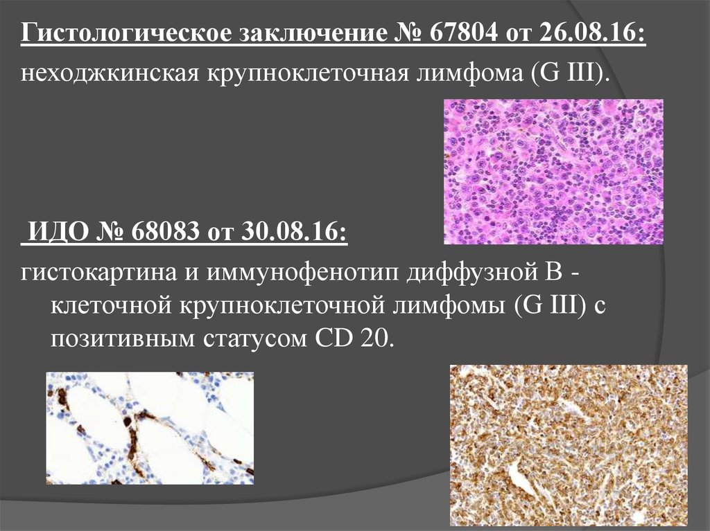 Диффузная неходжкинская