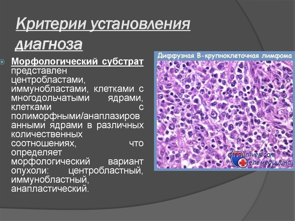 Диффузная крупноклеточная в клеточная. Диффузная крупноклеточная в-клеточная лимфома гистология. B клеточная лимфома микропрепарат. Крупноклеточная лимфома гистология.