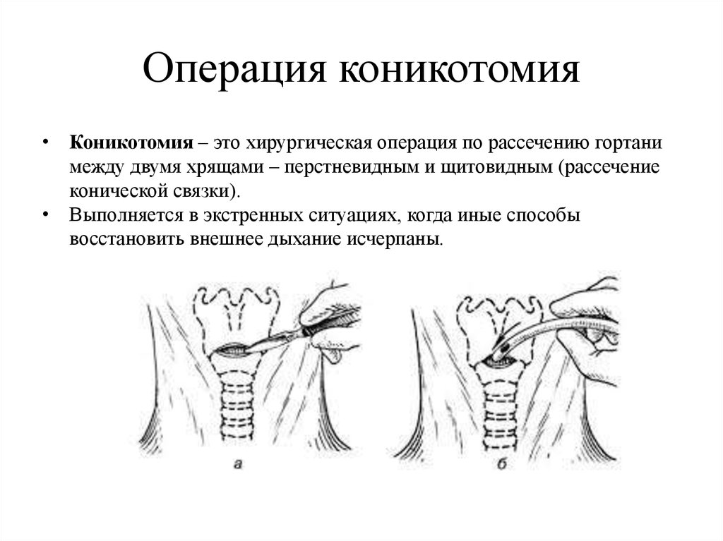 Трахеостома показания. Коникотомия этапы операции. Коникотомия анатомические ориентиры. Пункция перстнещитовидной мембраны. Коникотомия алгоритм выполнения.