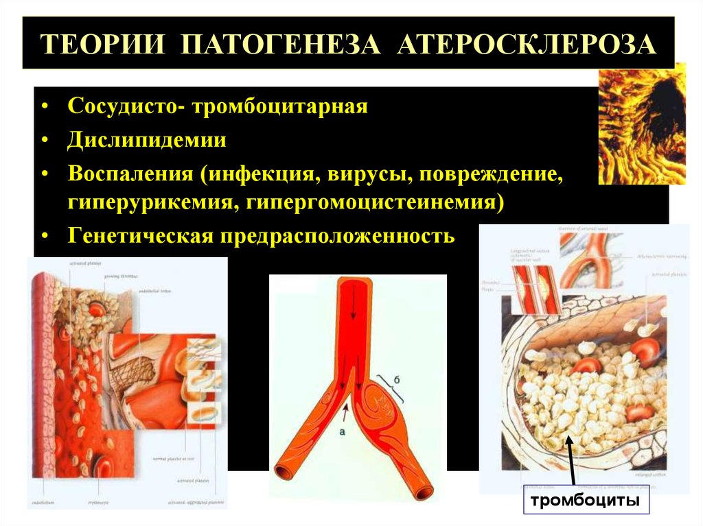 Атеросклероз этиология