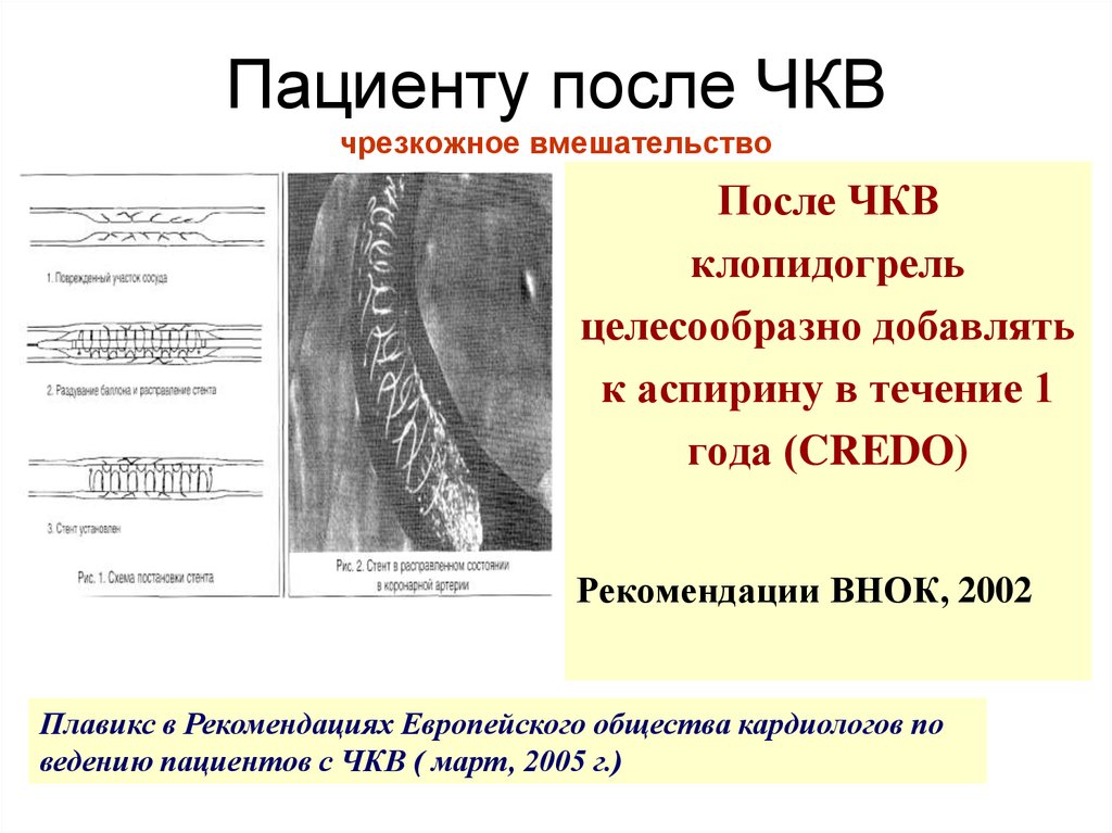 Чкв в кардиологии. Чрескожное коронарное вмешательство (ЧКВ). Рекомендации по ведению пациентов после ЧКВ.