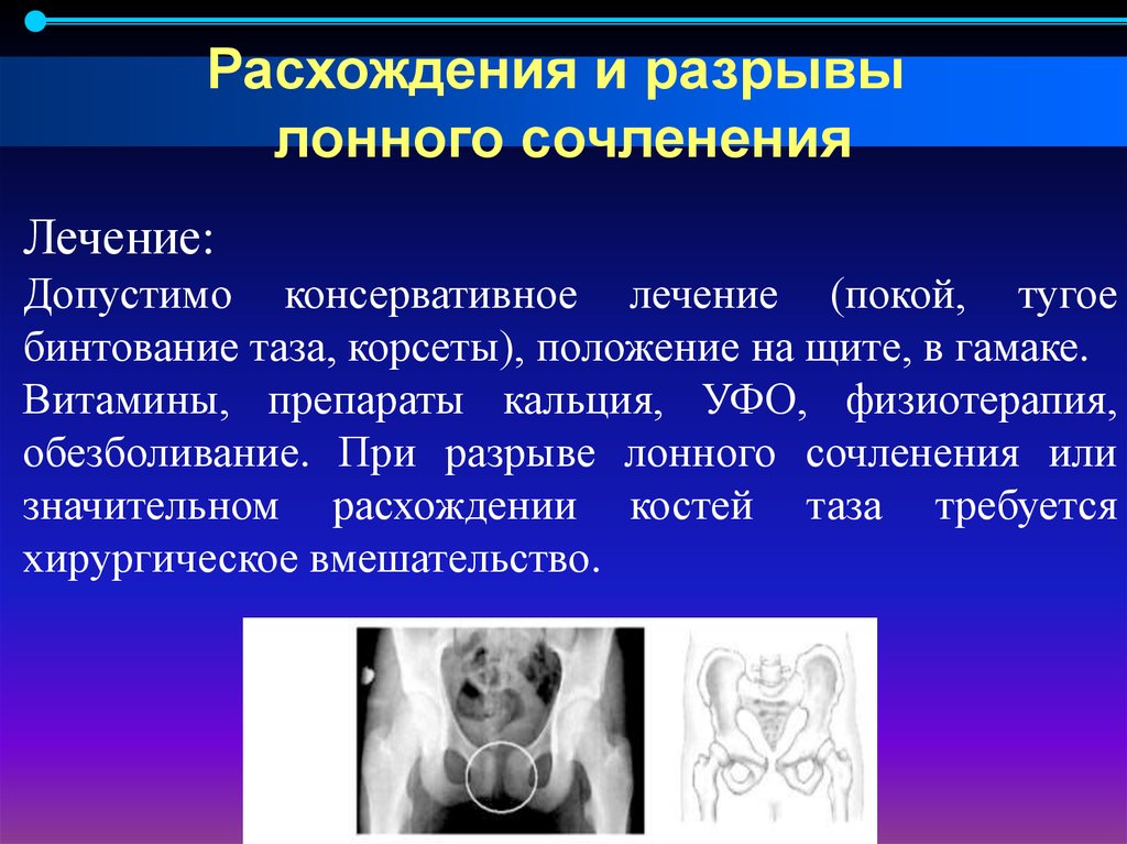 Узи лонного. Расхождение лонного сочленения. Разрыв лонного сочленения клиника. Расхождение и разрыв лонного сочленения. Разрыв лонного сочленения УЗИ.