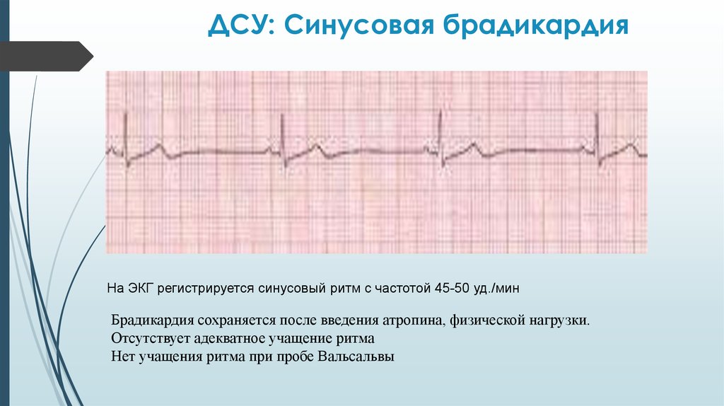 Что значит синусовый ритм сердца на экг. ЭКГ при синусовой брадикардии. Синусовая брадикардия ЭКГ признаки. Синусовая брадикардия на ЭКГ. Синусовая брадикардия ЭКГ проявления.