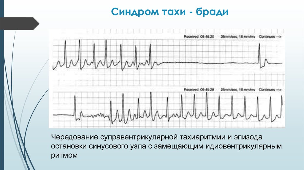 Синусовая тахикардия карта вызова