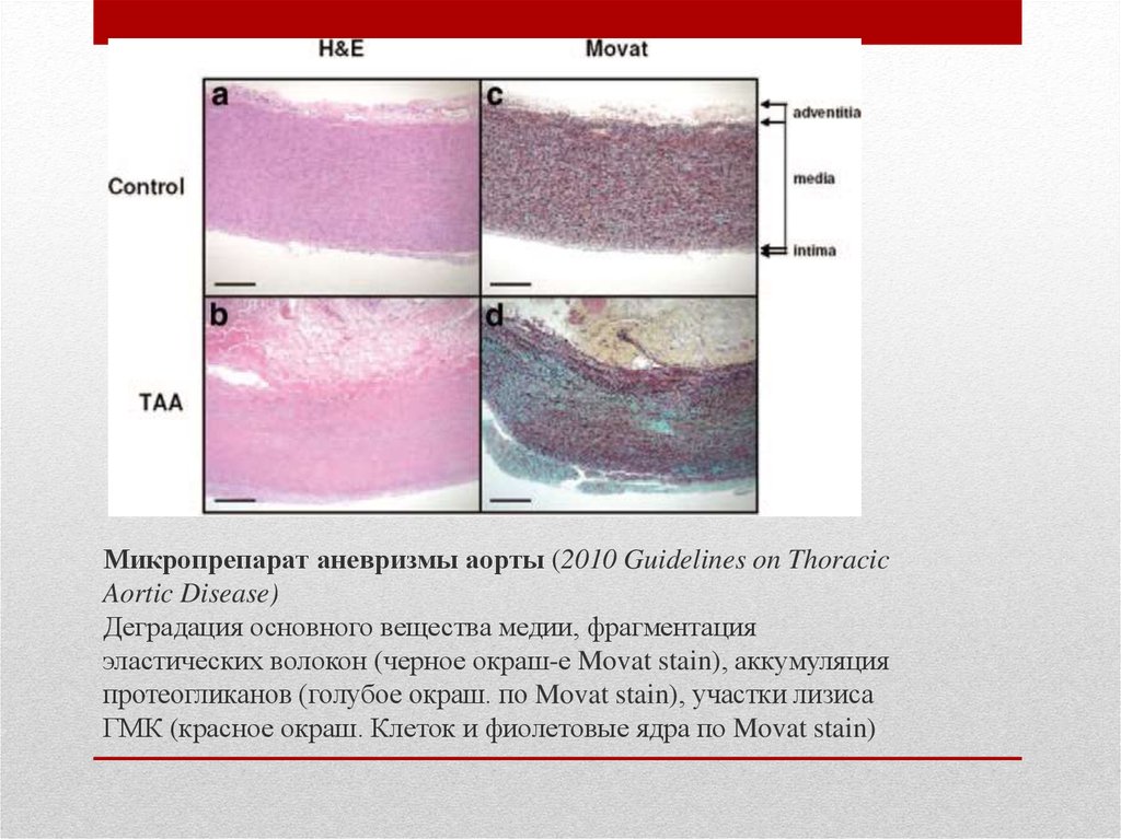 Микроскопическая картина атеросклероза аорты