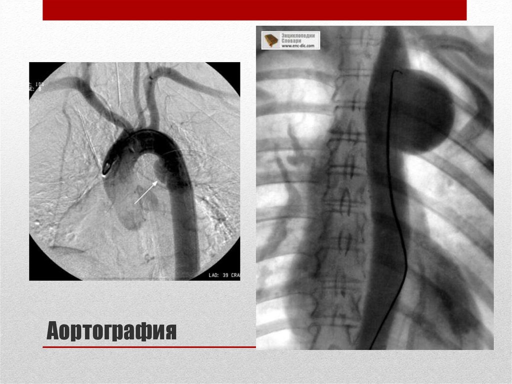 Аневризма грудной аорты фото