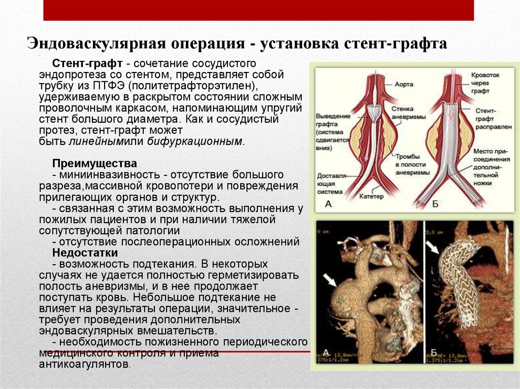 Эндоваскулярное протезирование митрального клапана