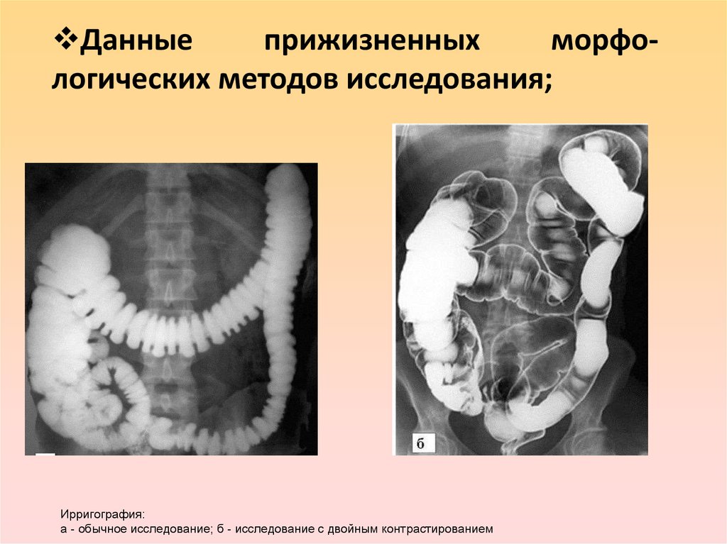 Ирригография. Ирригография с двойным контрастированием. Ирригография методика. Ирригография фазы контрастирования. Метод двойного контрастирования.