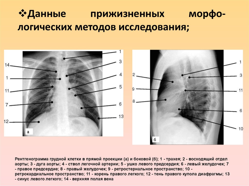 Прямая и боковая проекция. Ретрокардиальное пространство на боковой рентгенограмме. Рентгенограмма грудной клетки в прямой проекции. Грудная клетка в прямой и боковой проекции. Боковая проекция грудной клетки.