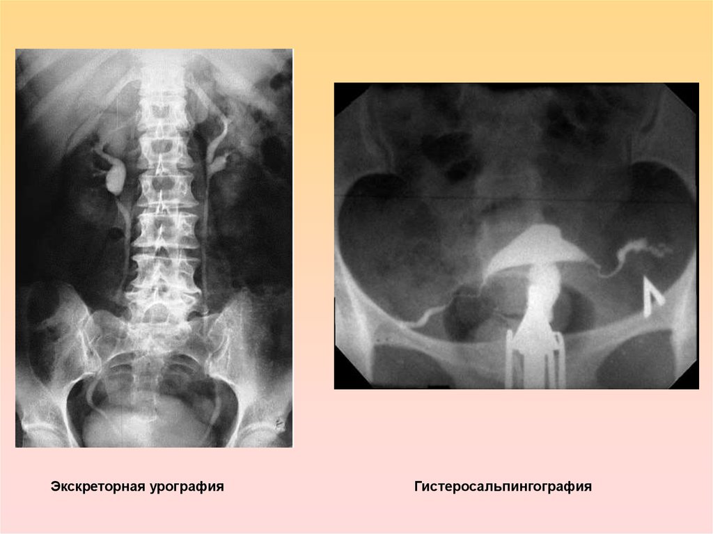 Экскреторная урография. Аномалии мочеточников экскреторная урография. Экскреторная урография норма. Экскреторная урография неполное удвоение ЧЛС. Обзорная+экскреторная урография Омнипак.