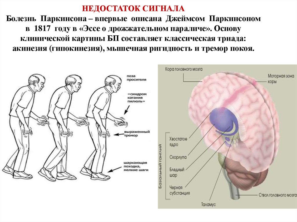 Какая болезнь паркинсона. Болезнь Паркинсона. Синдром Паркинсона. Дрожательный паралич болезнь Паркинсона. Клинические проявления болезни Паркинсона.