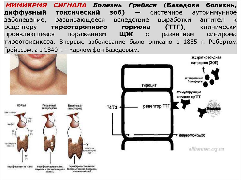 Рецепторы ттг. Болезнь Грейвса антитела. Диффузный токсический зоб антитела. Болезнь Грейвса ТТГ. ТТГ при болезни Грейвса.