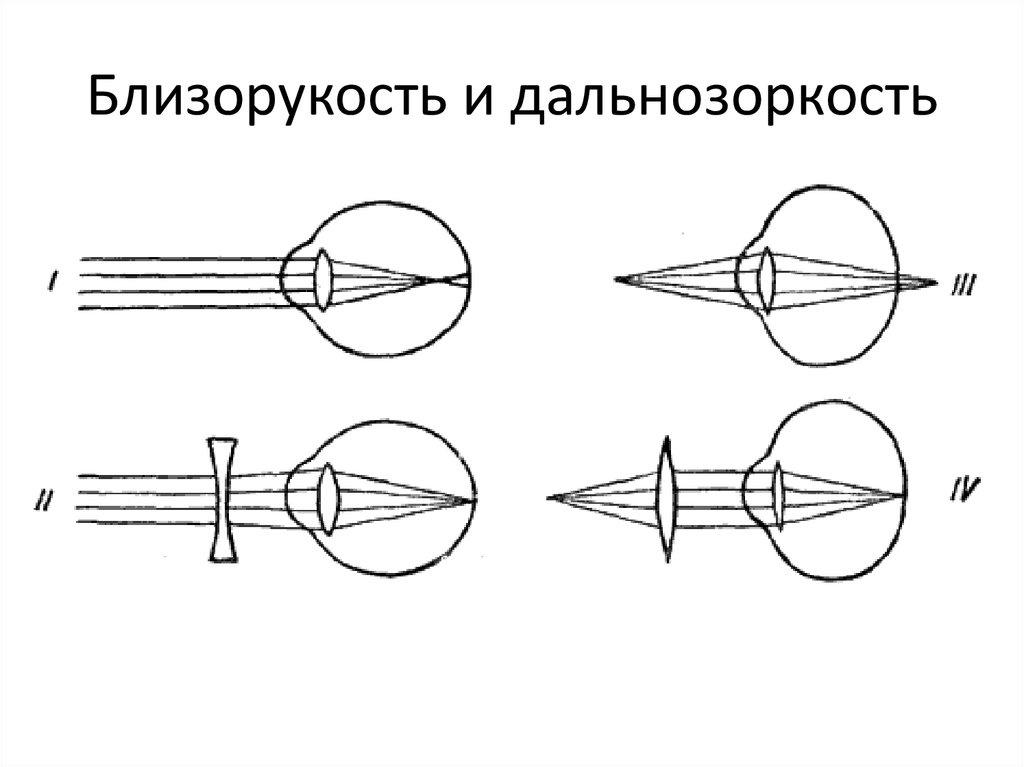 Рисунок дальнозоркого глаза