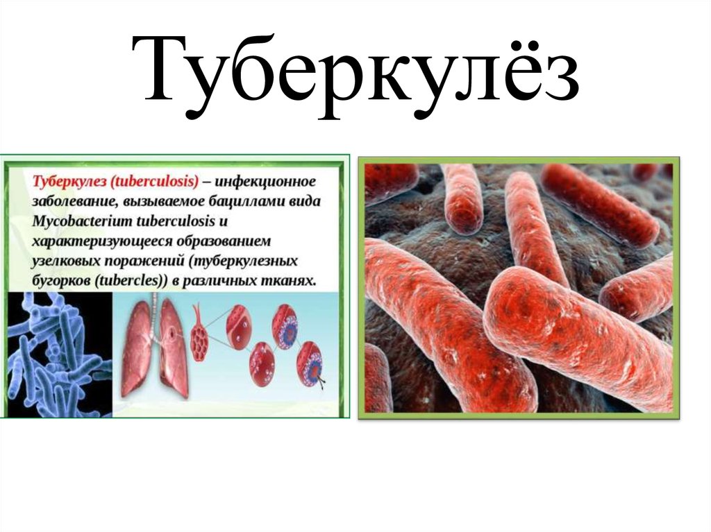 Туберкулёз
