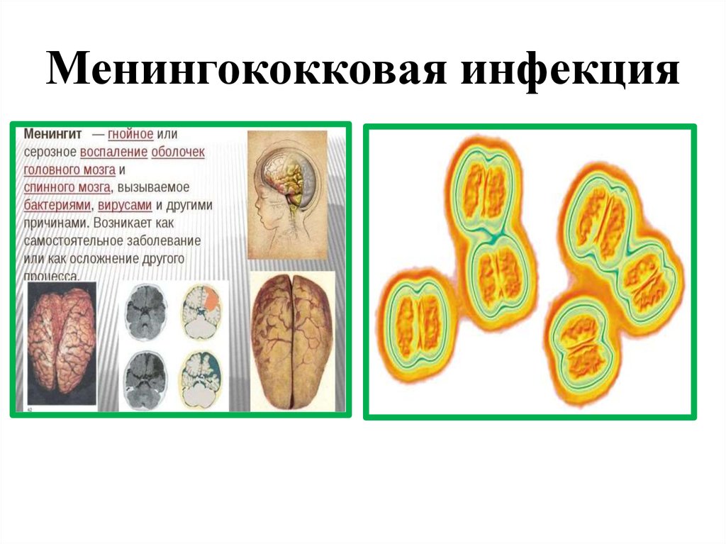 Менингококковая инфекция