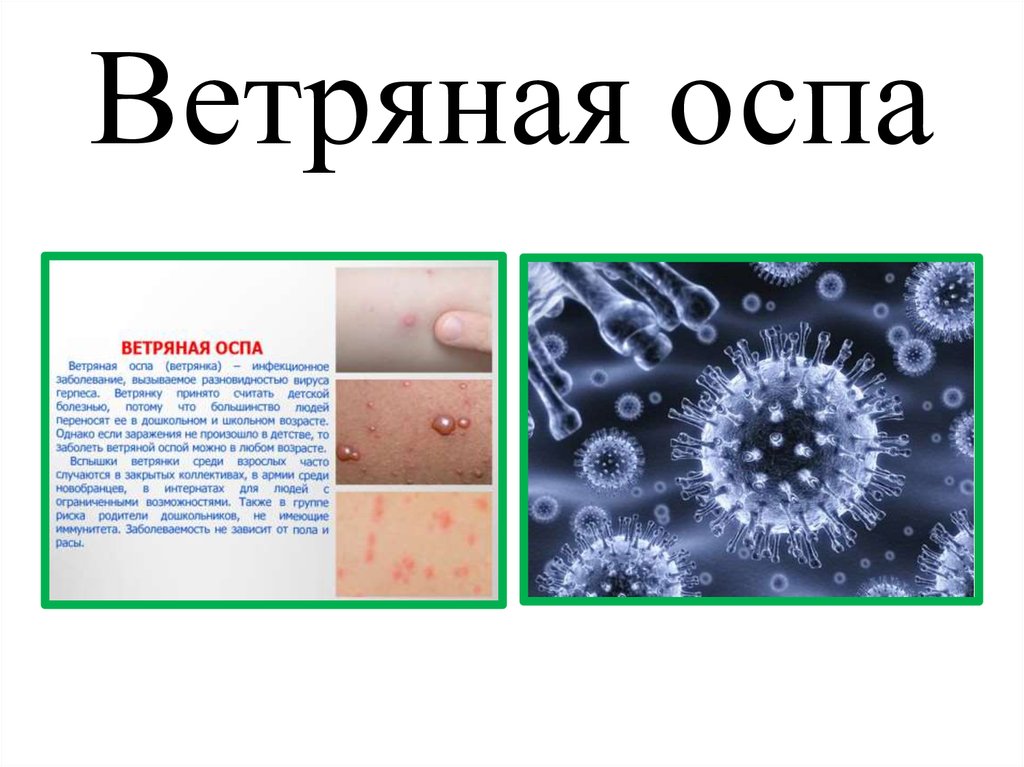 Ветряная оспа