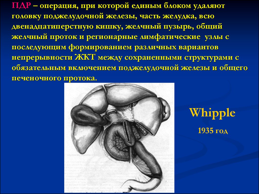 Панкреатодуоденальная резекция ход операции в схемах