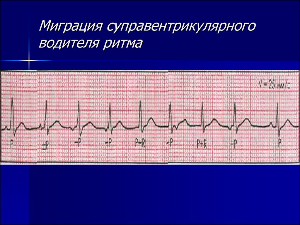 Миграция ритма. Миграция суправентрикулярного водителя ритма на ЭКГ. Миграция наджелудочкового водителя ритма на ЭКГ. ЭКГ при миграции водителя ритма по предсердиям. Суправентрикулярный ритм на ЭКГ.