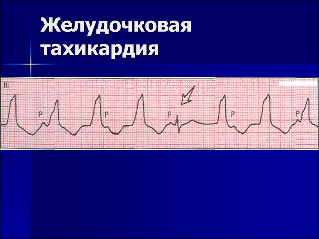 Желудочковый ритм. Пароксизмальная желудочковая тахикардия на ЭКГ. Желудочковая тахикардия на ЭКГ. ЭКГ при желудочковой тахикардии. Тахикардия желудочков на ЭКГ.