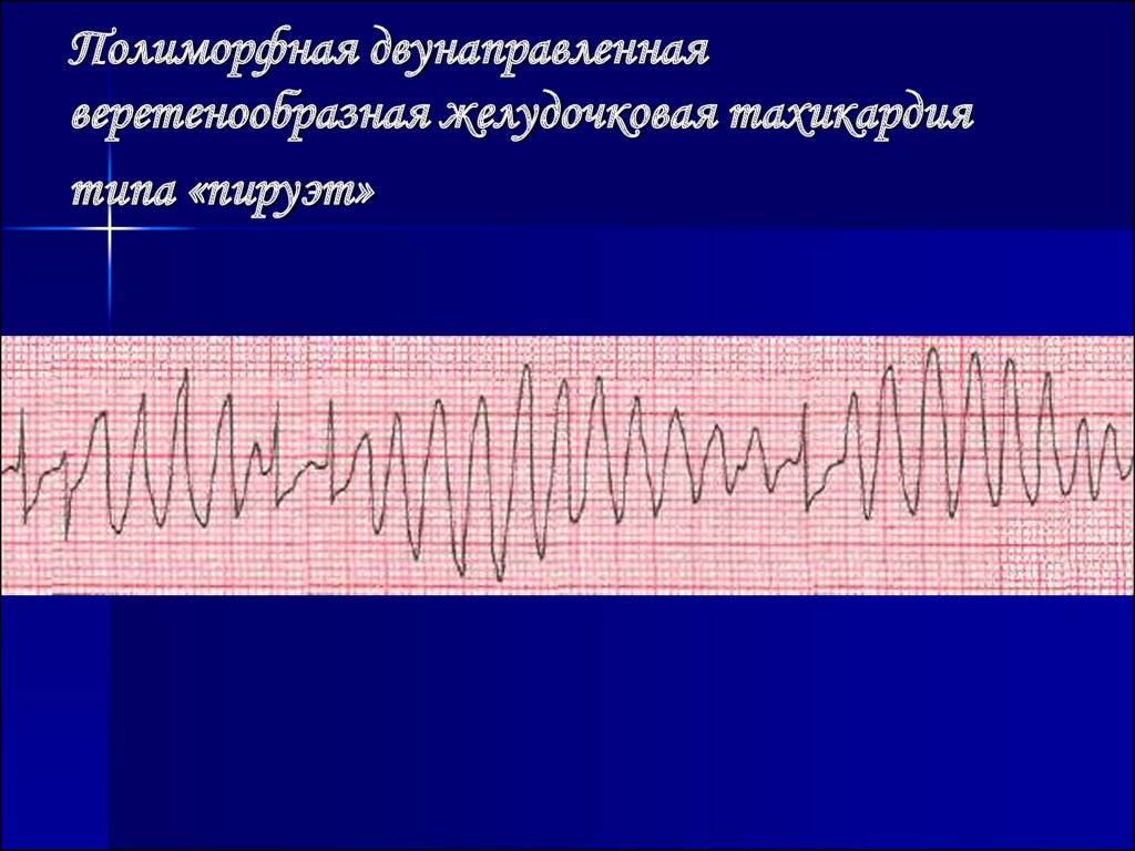 Желудочковое нарушение. Желудочковая тахикардия типа Пируэт. Желудочковая тахикардия Пируэт на ЭКГ. Полиморфная желудочковая тахикардия типа Пируэт на ЭКГ. Пируэтная желудочковая тахикардия ЭКГ.