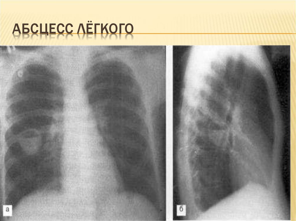 Лучевая картина абсцесса легких