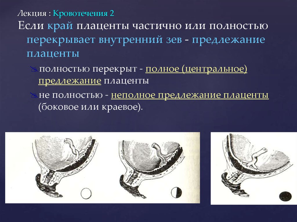 Неполное боковое предлежание плаценты. Предлежание плаценты внутренний зев. Предлежание плаценты УЗИ. Плацента перекрывает внутренний зев.