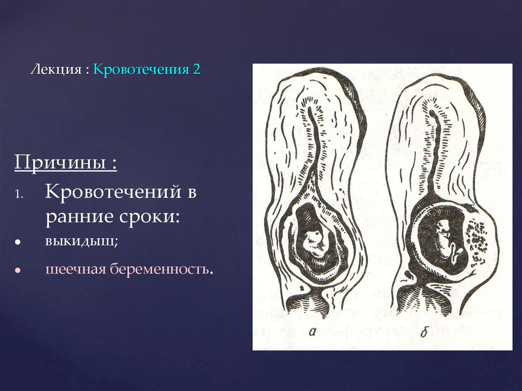 Лекция : Кровотечения 2