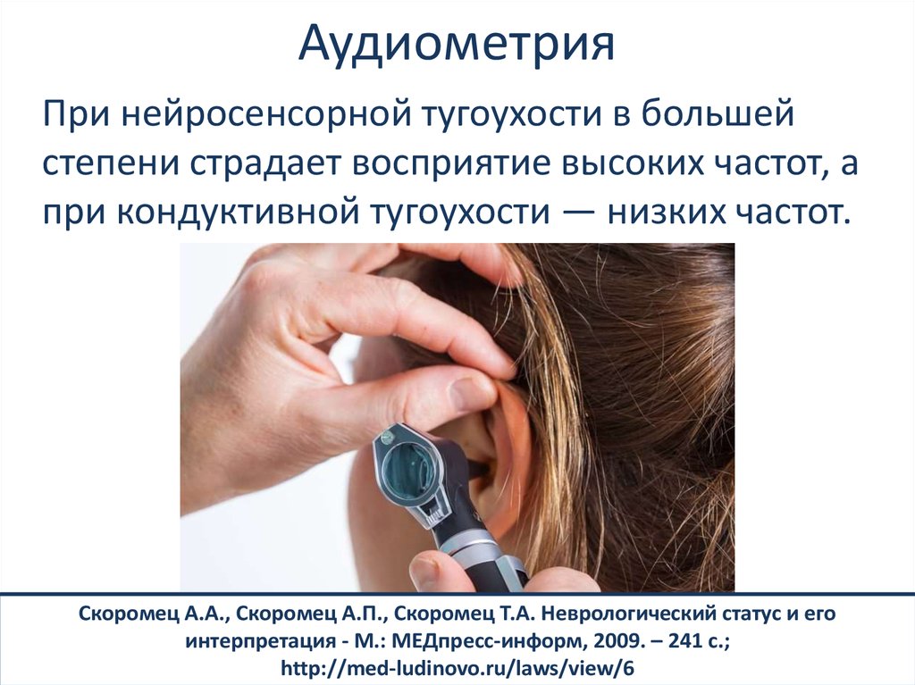 Осложнение слуха. Аудиометрия нейросенсорная тугоухость. Нейросенсорная тугоухость неврологический статус. Нейросенсорная тугоухость 2 степени аудиометрия. Неврологический статус при нейросенсорной тугоухости.