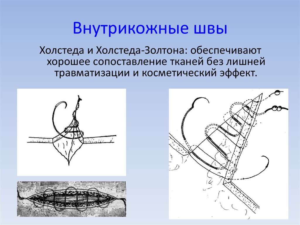 Виды хирургических швов презентация