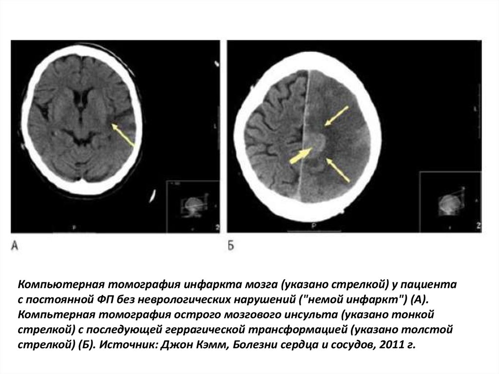 Есть инфаркт мозга. Бифокальный инфаркт головного мозга. Инфаркт мозга осложнения. Инфаркт головного мозга кт.