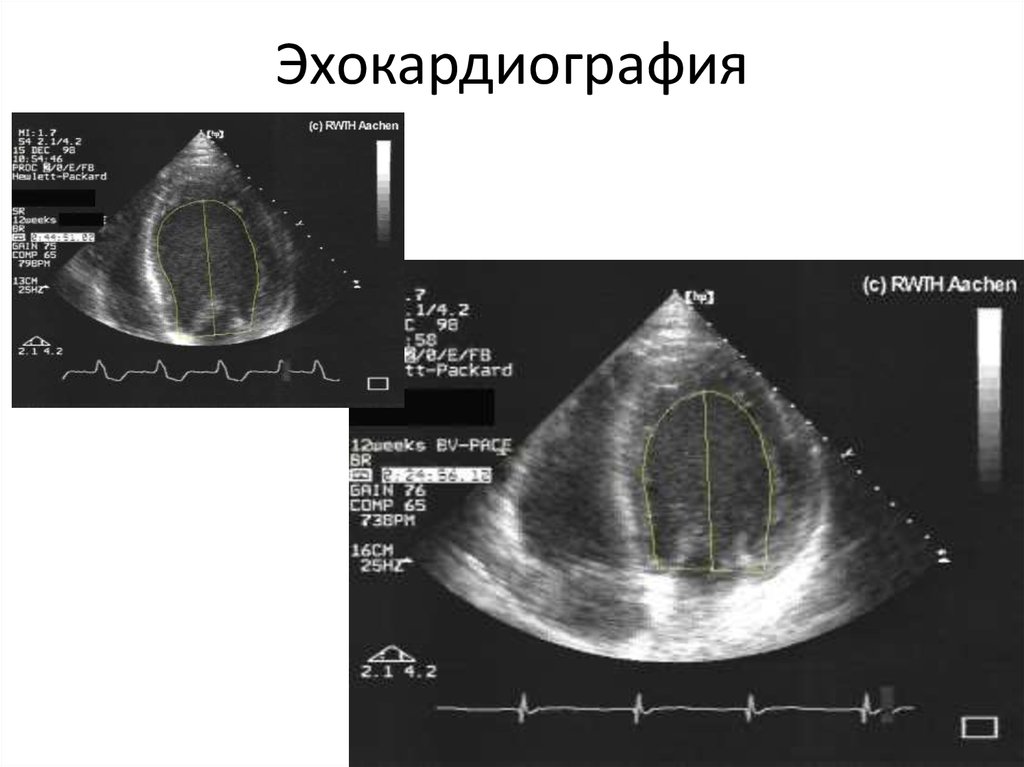 Что такое эхо кг. Мерцательная аритмия ЭХОКГ. Фибрилляция предсердий ЭХОКГ. ЭХОКГ при фибрилляции предсердий. Трепетание предсердий эхокардиография.