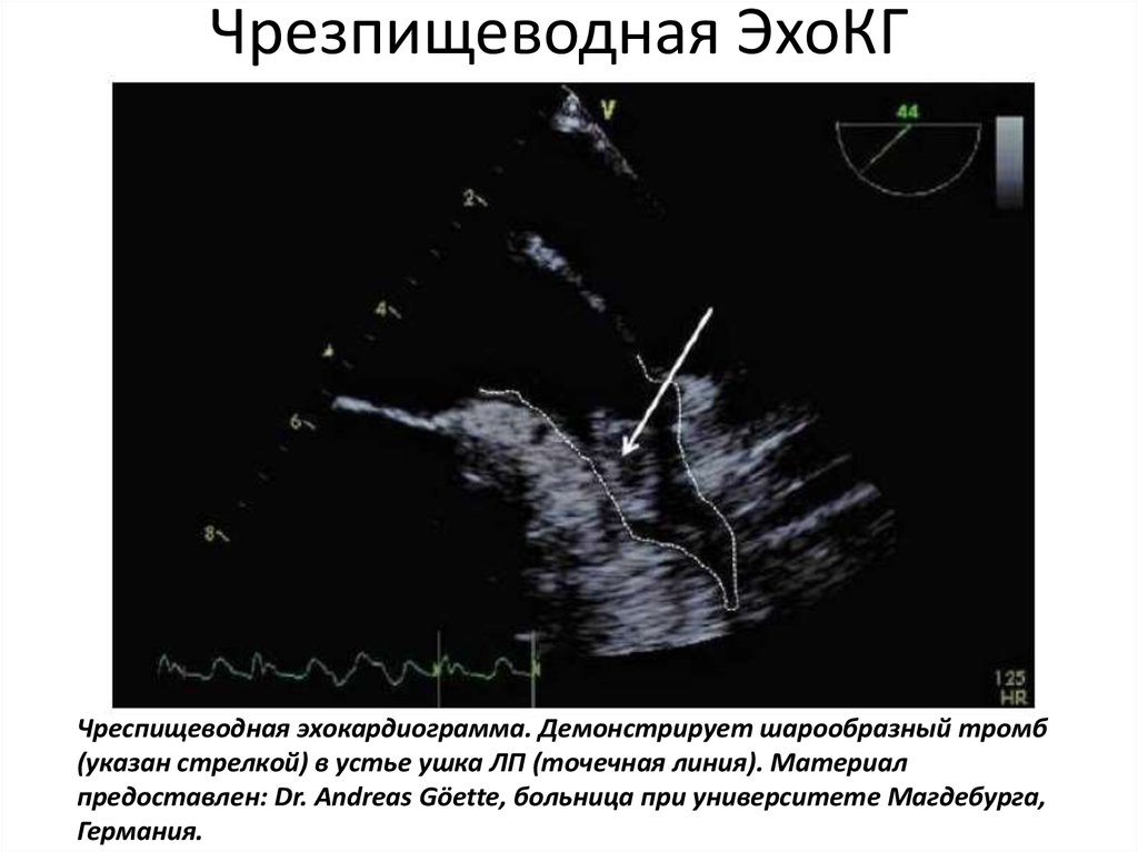 Тромбоз ушка предсердия. Эхокардиография при фибрилляции предсердий. ЭХОКГ при фибрилляции предсердий заключение. УЗИ сердца при фибрилляции предсердий. Эхо кг при фибрилляции предсердий.