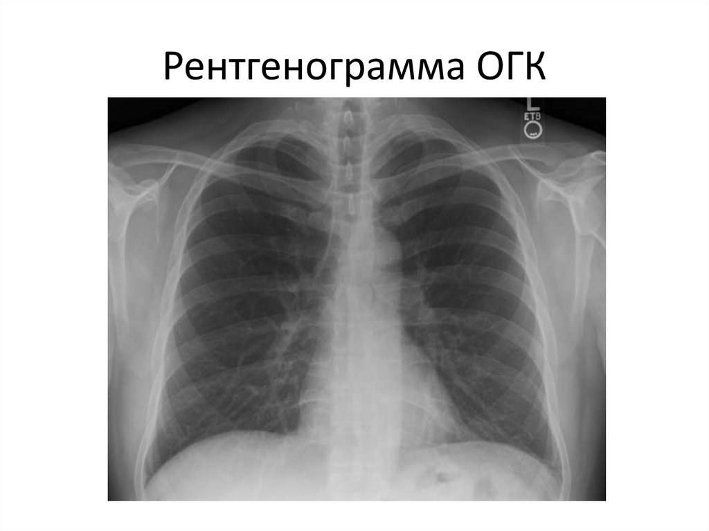 Рентгенограмма ОГК