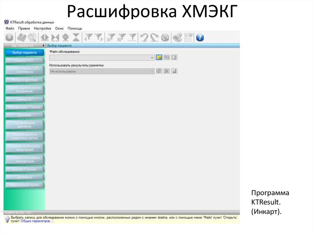 Расшифровка ХМЭКГ