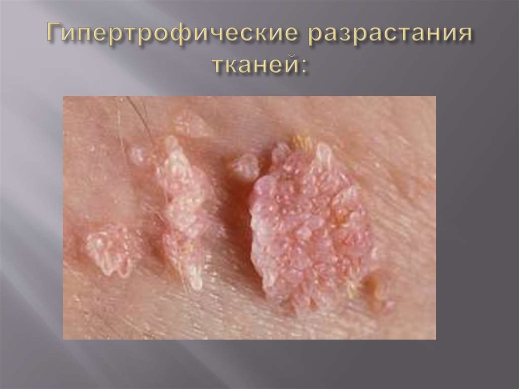 Гипертрофические разрастания тканей: