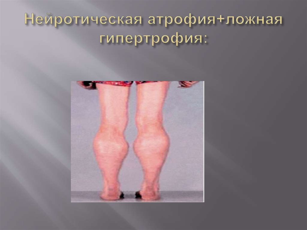 Нейротическая атрофия+ложная гипертрофия: