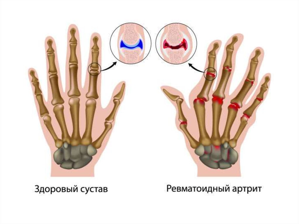 Реферат: Ревматоидный артрит