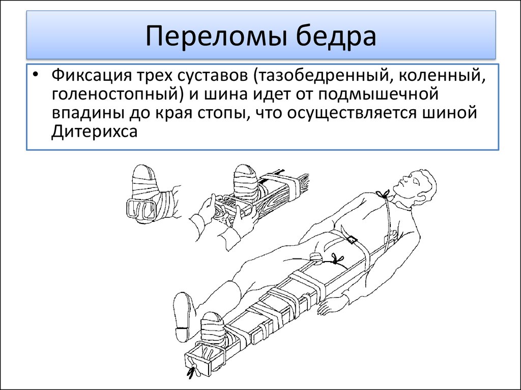 Сколько суставов необходимо зафиксировать при иммобилизации. Какие суставы должна фиксировать шина при переломе бедра. При переломе бедренной кости фиксируют:. Шина при переломе бедра 3 шины. При переломе бедренной кости необходимо зафиксировать:.