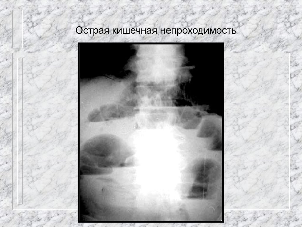 Острая кишечная непроходимость. Рентген при аппендиците. Острая кишечная непроходимость рентген проба Шварца. Непроходимость 12 перстной кишки рентген.