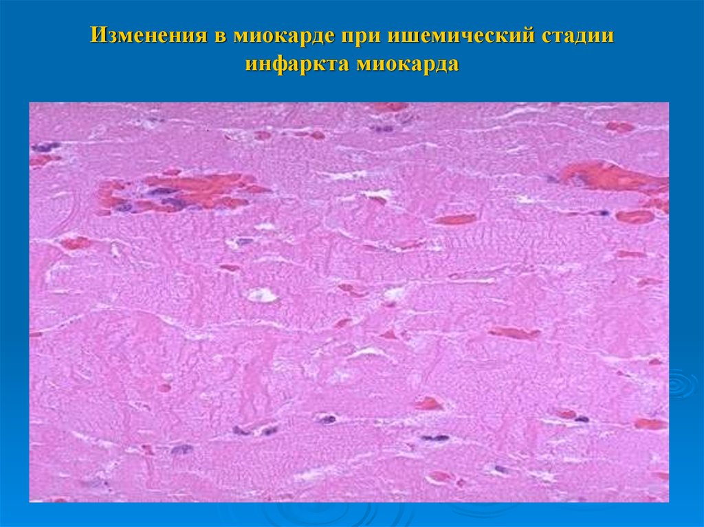 Ибс патологическая анатомия презентация