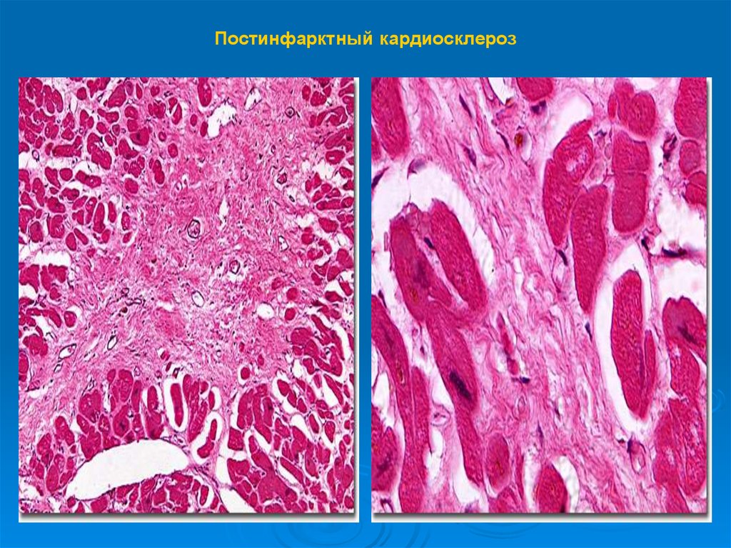 Образование рубцовой ткани