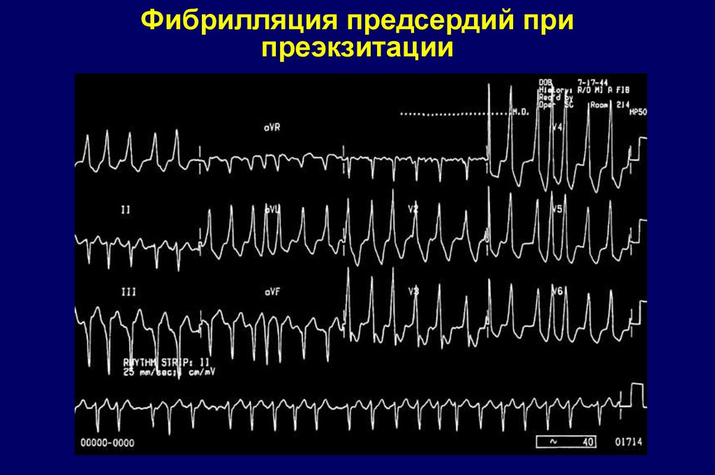 Презентация на тему фибрилляция предсердий